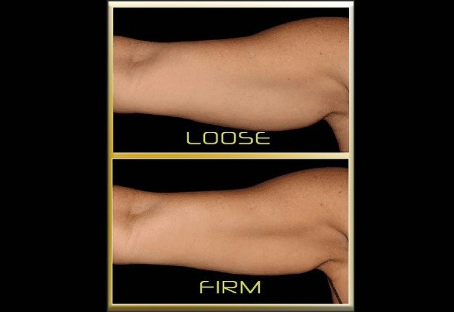 Fitness Beauty Ko LLC | Underarm Toner